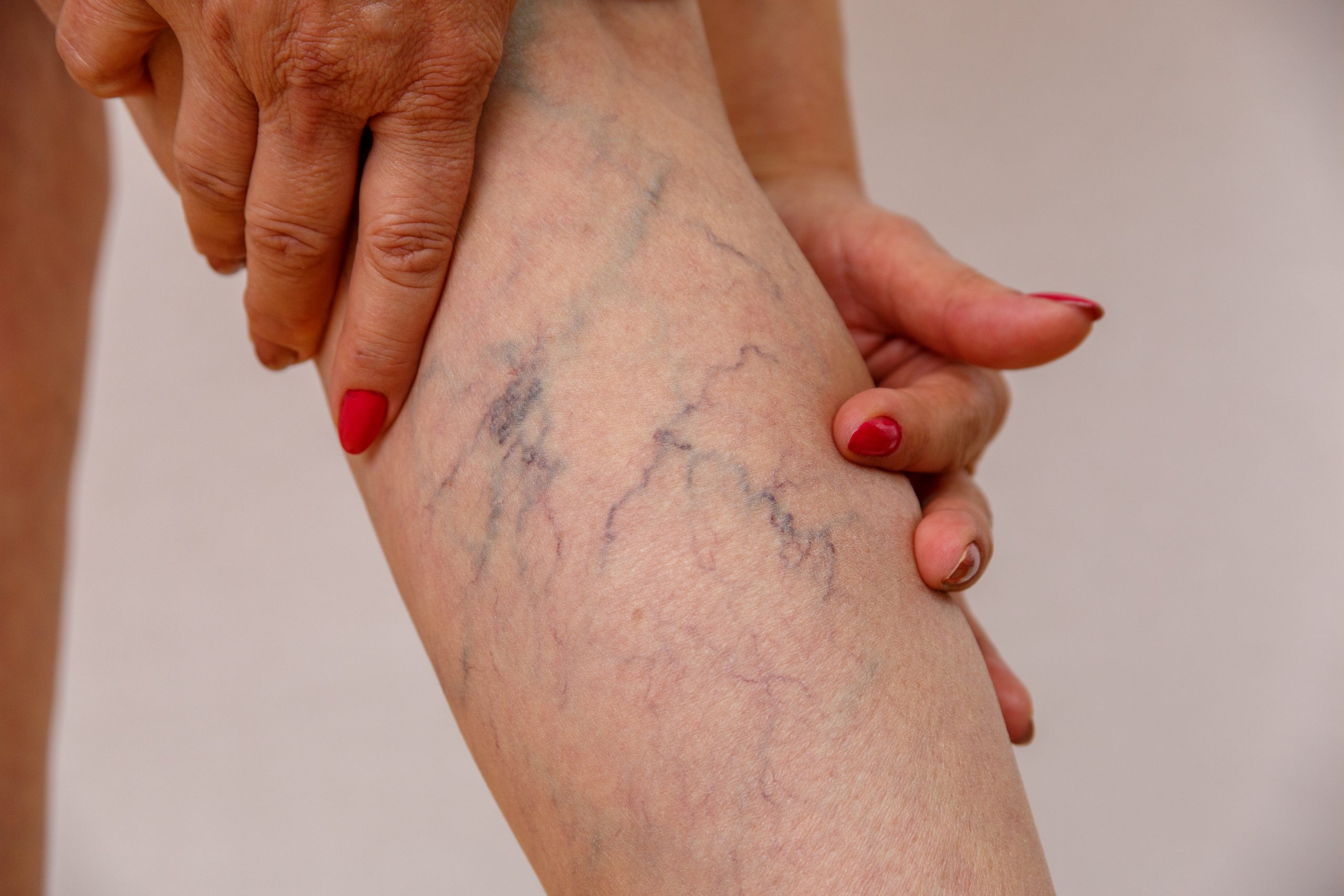 Are varicose vein treatments covered by insurance