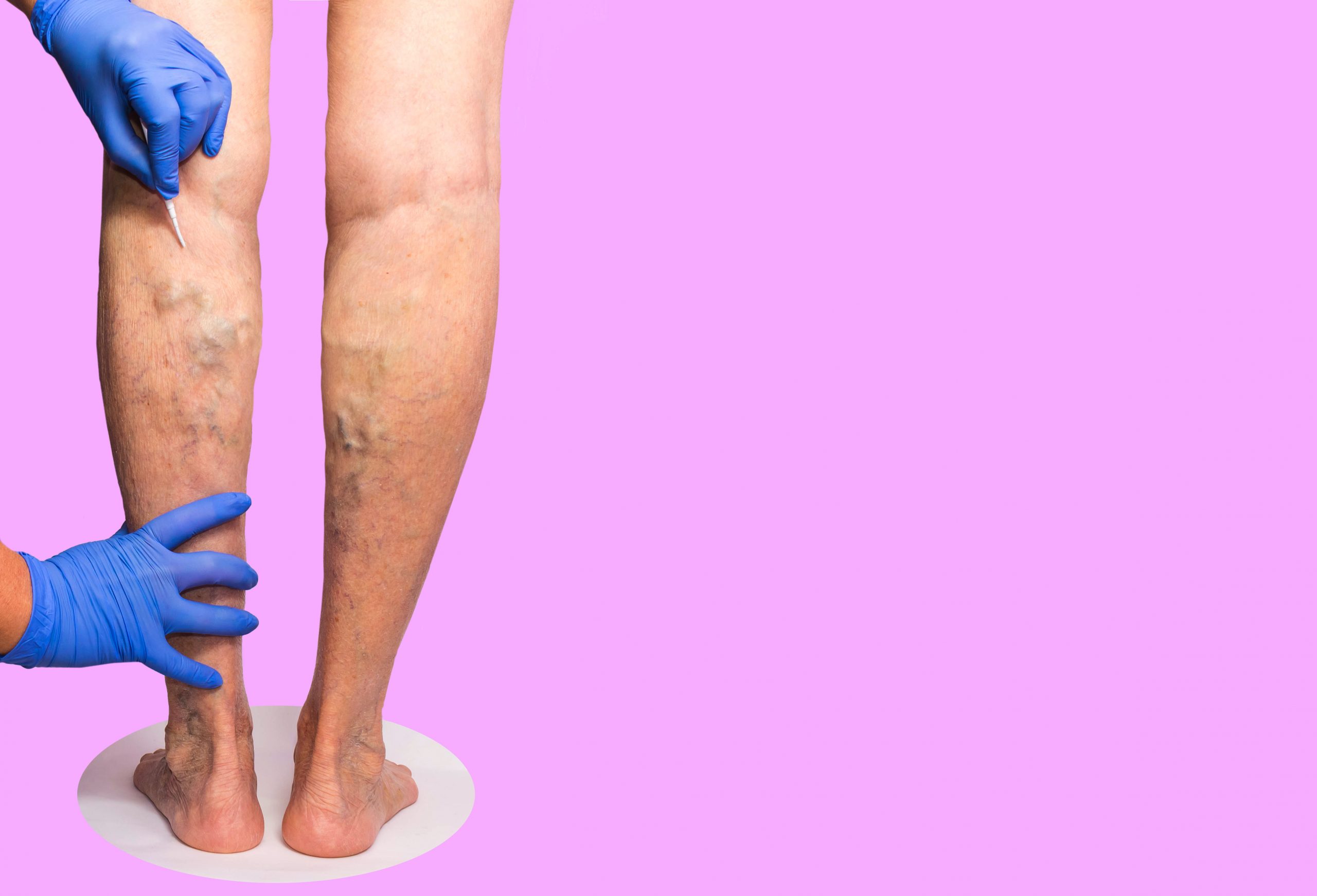 What Are The Latest Treatment Options For Varicose Veins?