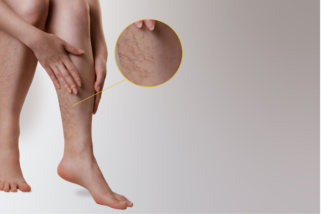 Vein with Callout-left leg only What type of doctor treats varicose veins?
