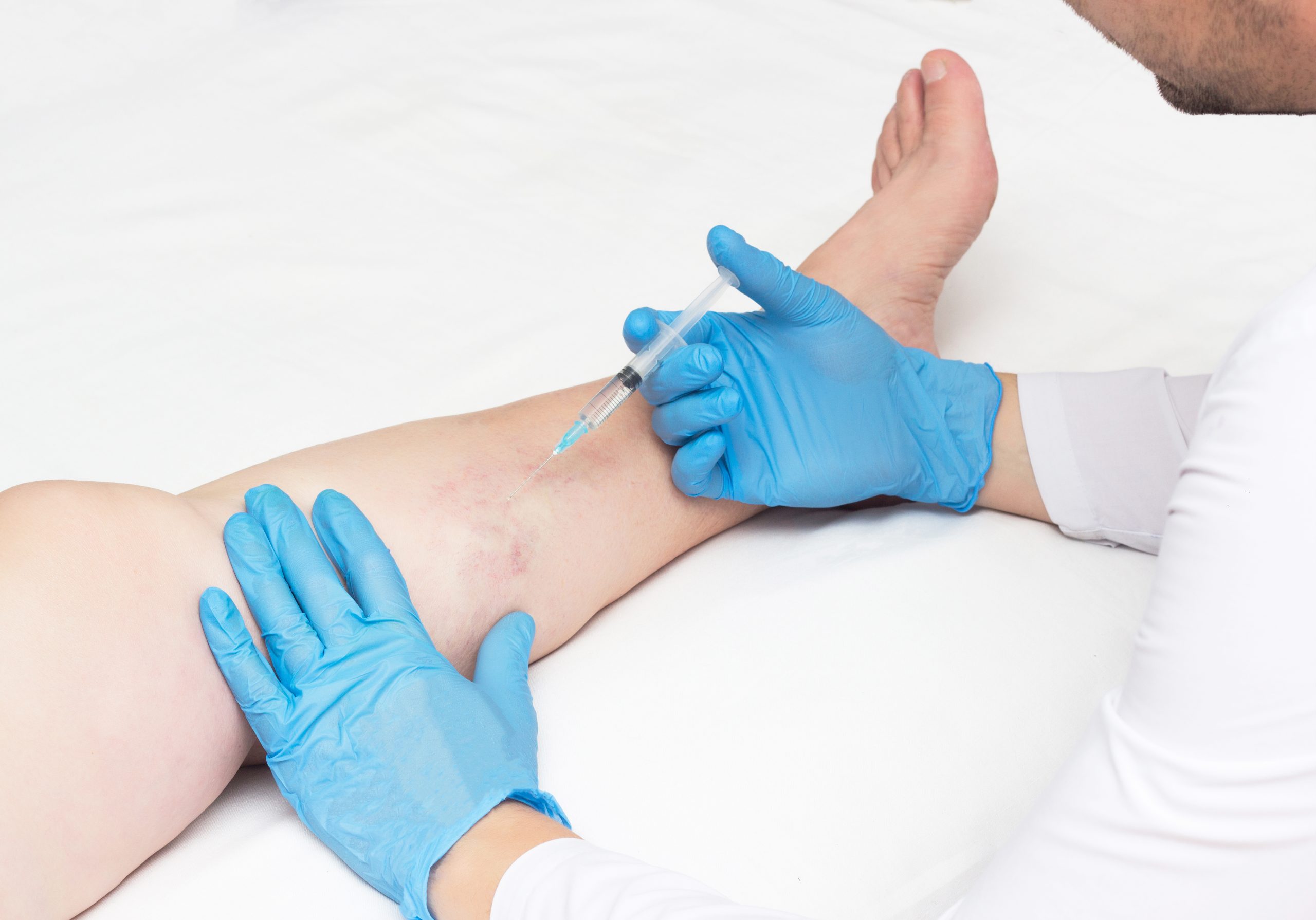 Foam Sclerotherapy: An Advanced Non-Surgical Technique For Varicose Vein Removal In Long Island