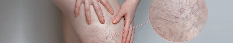 Spider vein call outs