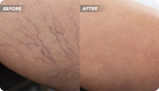 VTCBefore-After-3 What is a Vein Clinic?