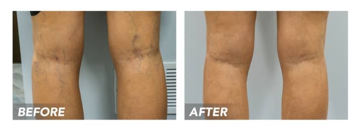 When to See a Vascular Doctor?